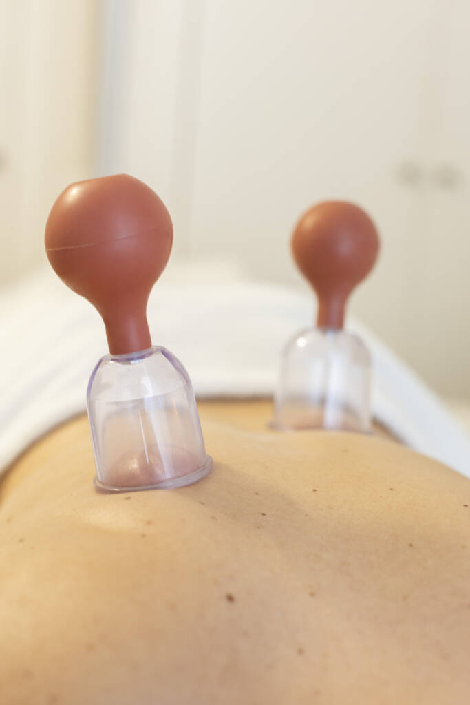 mankai cupping terapia ventosas